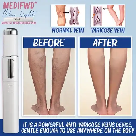 MediFwd Blue Light Therapy Varicose Veins Pen