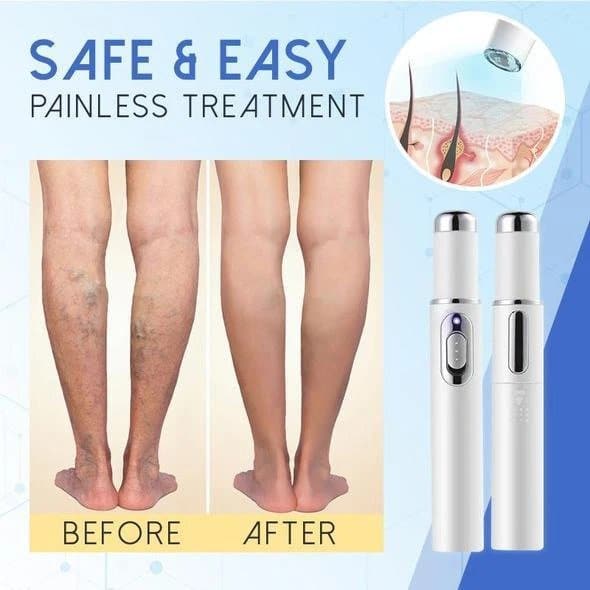 Blue Light Therapy Pen for Varicose Veins Low Prices Molooco Shop