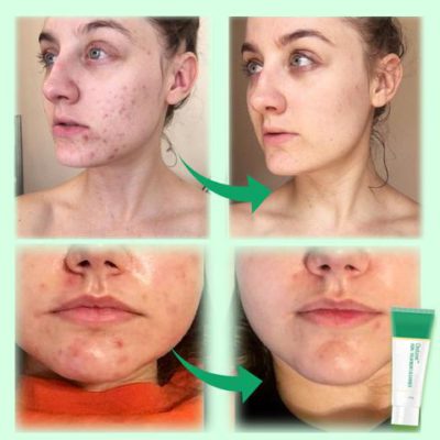 Detox Acne Treatment Cleanser