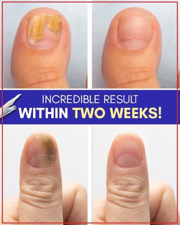 AntiFungal Blue Light Treatment Set Online Low Prices Molooco Shop