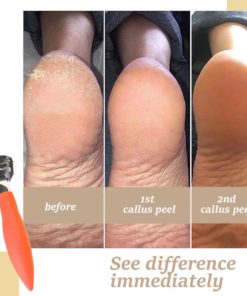 CallusRemedy Foot Tool