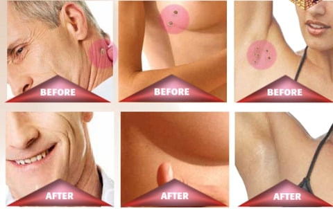 OFFImperfections Upgraded Skin Tag Removal,Skin Tag Removal,how to remove skin tags,get rid of skin tags,how to get rid of skin tags