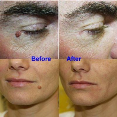 OFFImperfections Upgraded Skin Tag Removal,Skin Tag Removal,how to remove skin tags,get rid of skin tags,how to get rid of skin tags
