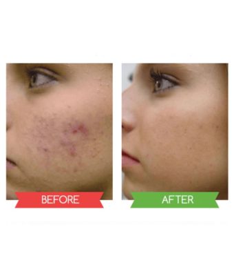 ការបំបាត់មុនក្បាលខ្មៅរបាំងមុខគួរឱ្យស្ញប់ស្ញែងឈុតម៉ាស់ខ្មៅរបាំងខ្មៅ - លាបម៉ាសបិទ