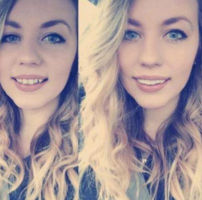 Instant Teeth Veneer,missing teeth,Teeth Veneer,Veneers,teeth