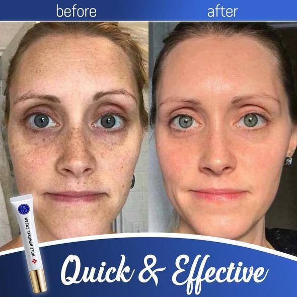 mole removal cream before and after
