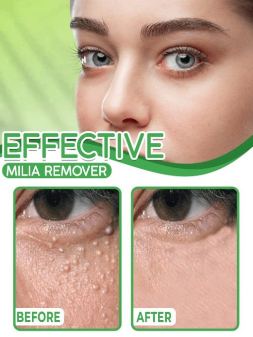 Milia Removal Cream, Eye Milia крем за отстраняване, Eye Milia Removal, Eye Milia, крем