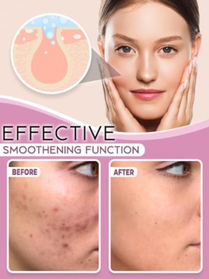 Acne Clearing Light Therapy,Acne Clearing,Light Therapy,Acne Clearing Light