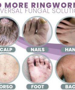 3 Days Anti Fungal Rash Cream,Anti Fungal Rash Cream,Rash Cream,3 Days Anti Fungal