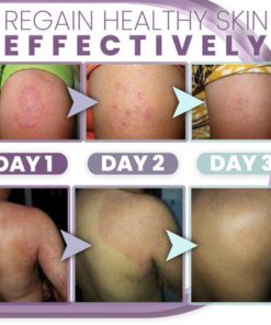 3 Days Anti Fungal Rash Cream,Anti Fungal Rash Cream,Rash Cream,3 Days Anti Fungal