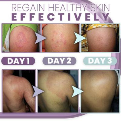 3 Days Anti Fungal Rash Cream,Anti Fungal Rash Cream,Rash Cream,3 Days Anti Fungal