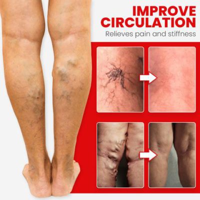 Red Agate,Varicose,Vein Cure,Anklet,Red Agate Varicose Vein Cure Anklet