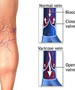 Varicose Veins Treatment Cream,Veins Treatment Cream,Treatment Cream,Varicose Veins Treatment,Varicose Veins