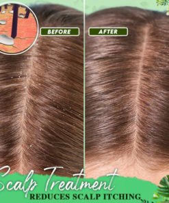 Anti-Dandruff Treatment Essence,Treatment Essence,Anti-Dandruff