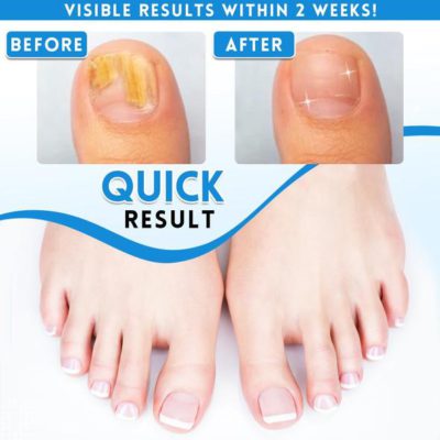 Anti-Fungus Repairing Pen,Fungus Repairing Pen,Repairing Pen,Fungus Repairing,Anti-Fungus