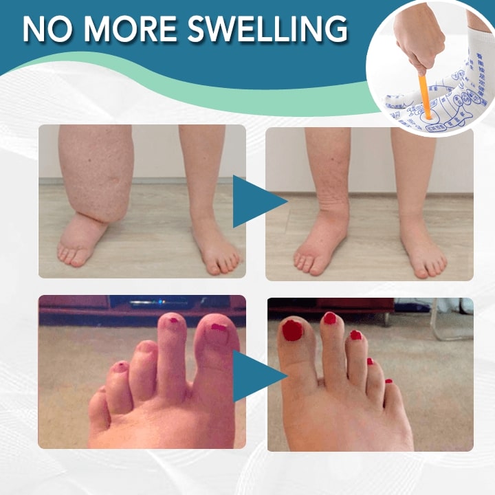 Anti-Swelling Acupressure Therapy Socks,Acupressure Therapy Socks,Therapy Socks,Acupressure Therapy,Anti-Swelling