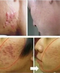 Scar Remover Cream,Acne Scar Remover,Acne Scar,Remover Cream