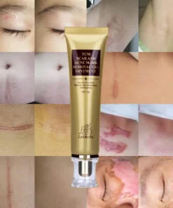 Scar Remover Cream,Acne Scar Remover,Acne Scar,Remover Cream