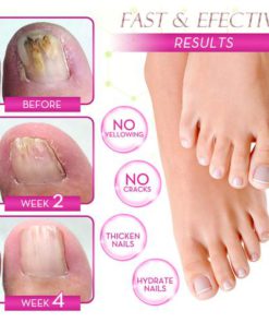 Ginger Health Toe Repair Treatment Gel,Health Toe Repair Treatment Gel,Toe Repair Treatment Gel,Repair Treatment Gel,Treatment Gel