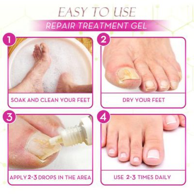 Ginger Health Toe Repair Treatment Gel,Health Toe Repair Treatment Gel,Toe Repair Treatment Gel,Repair Treatment Gel,Treatment Gel