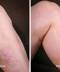 Varicose Veins Treatment Cream,Veins Treatment Cream,Treatment Cream,Varicose Veins Treatment,Varicose Veins