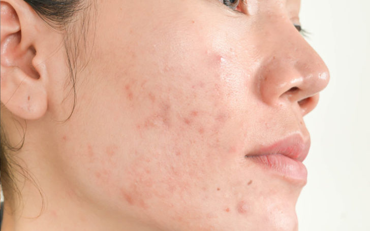 subclinical acne