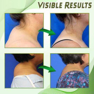 Dowager's Hump Neck Drain Patch,Hump Neck,Drain Patch,Neck Drain,Dowager's Hump