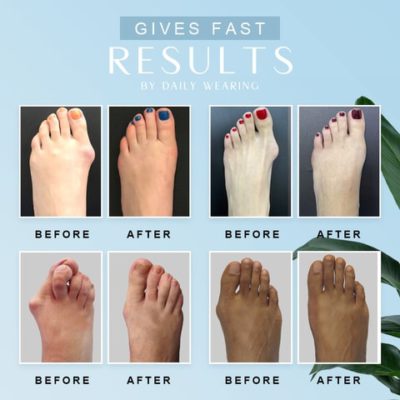 Elastic Two Toes Hallux Valgus Corrector,Hallux Valgus Corrector,Elastic Two Toes,Valgus Corrector