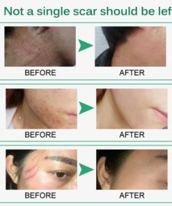 Scar Removal Cream,Scar Removal,Intensive Scar Removal Cream,Intensive Scar Removal