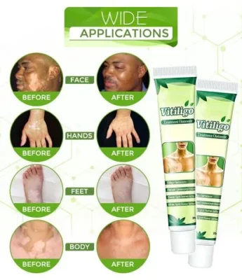 White Tag Treatment Moisturizing Cream,White Tag Treatment,Moisturizing Cream