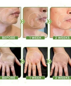 White Tag Treatment Moisturizing Cream,White Tag Treatment,Moisturizing Cream