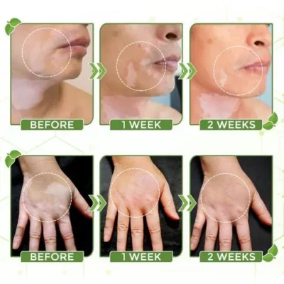 White Tag Treatment Moisturizing Cream,White Tag Treatment,Moisturizing Cream