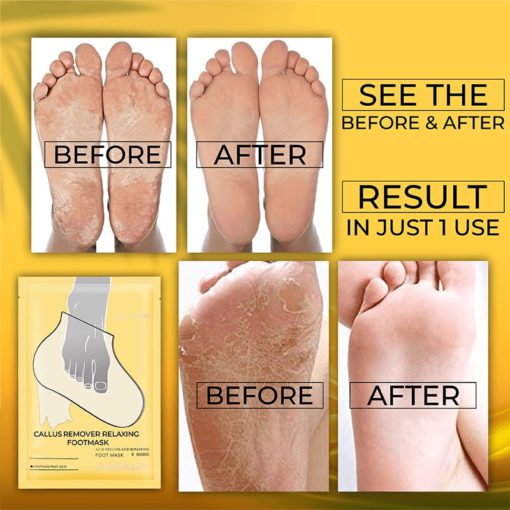 CallusRemover Relaxing FootMask