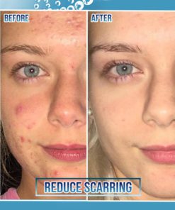 Miracle BlemishFree SkinCream