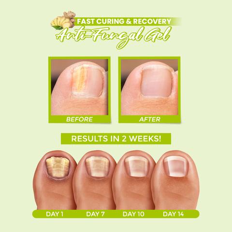 HealthyToe Anti-Fungal Gel,HealthyToe™ Anti-Fungal Gel,Anti-Fungal Gel