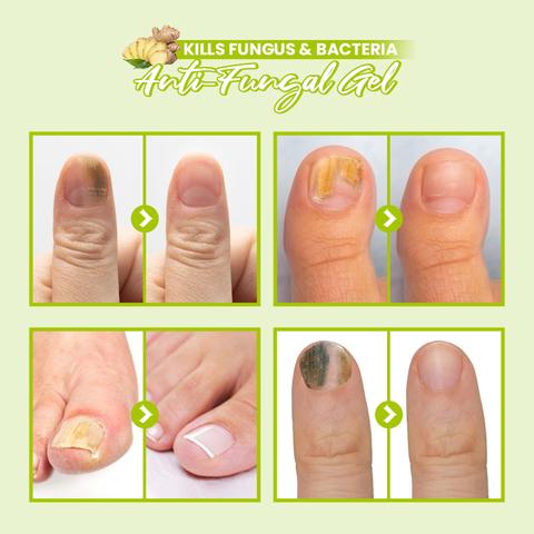 HealthyToe Anti-Fungal Gel,HealthyToe™ Anti-Fungal Gel,Anti-Fungal Gel