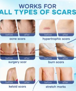 Vanish Scar Cream,Scar Cream