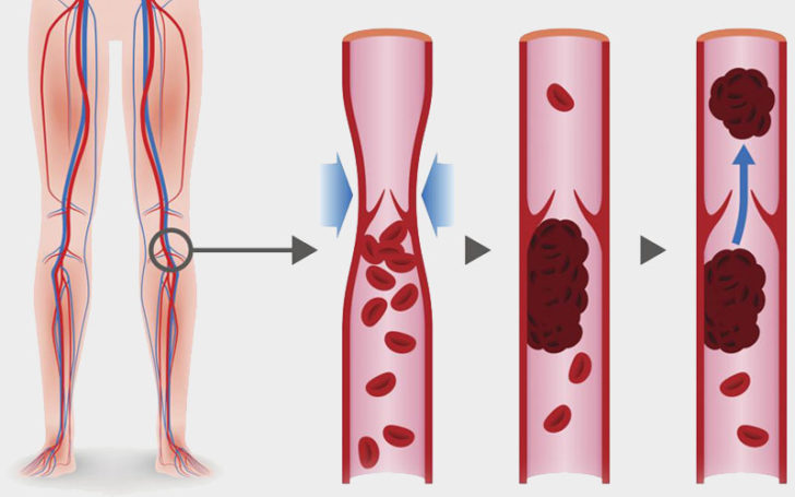 Behind Knee,Pain Behind Knee