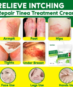 Tinea Cream,Herbal Tinealess Cream