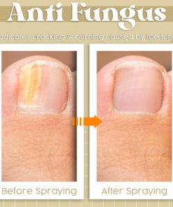 Anti Fungal Spray,Fungal Spray