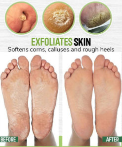 AntiFungal Foot Soak