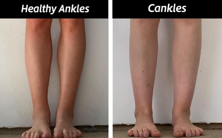 How to Tell If I Have Cankles?