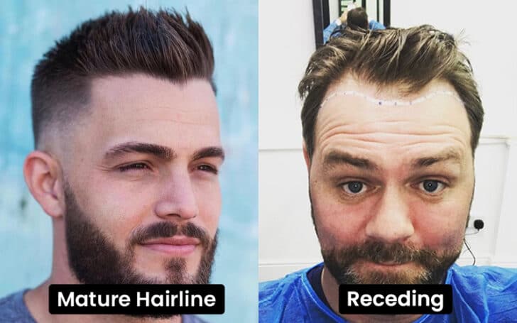 Mature Hairline