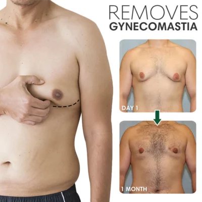 SoliPac Gynecomastia Reduction Ointment