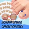 Ingrown Toenail Correction Patch