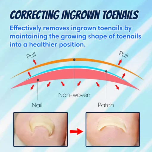 Ingrown Toenail Correction Patch