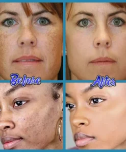Anti-Blemish Facial Cream