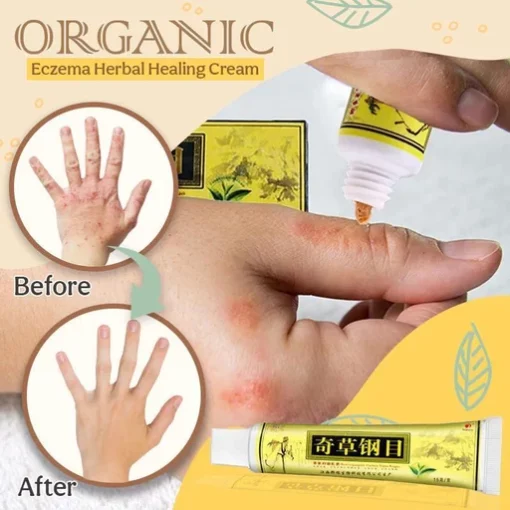 Organic Eczema Herbal Healing Cream Buy Today Get 55 Discount MOLOOCO