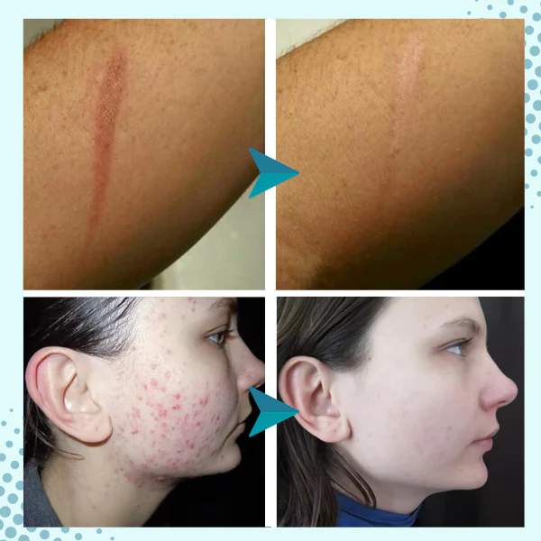 SkinFx™ Scar & Acne Bump Removal Cream - Image 6