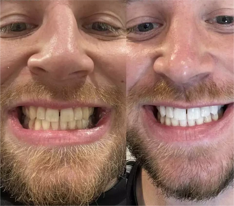 CLAIRE™ France Professional Teeth Whitening Essence - Image 3